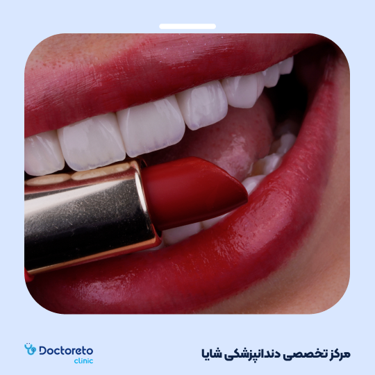 لمینت آی پی اس ایمکس تمام دیجیتال (هر واحد)