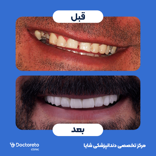 لمینت آی پی اس ایمکس تمام دیجیتال (هر واحد)