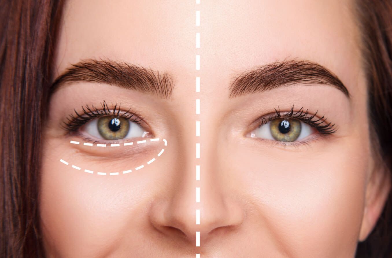 تزریق ژل زیرچشم با برند رووفیل (1cc)