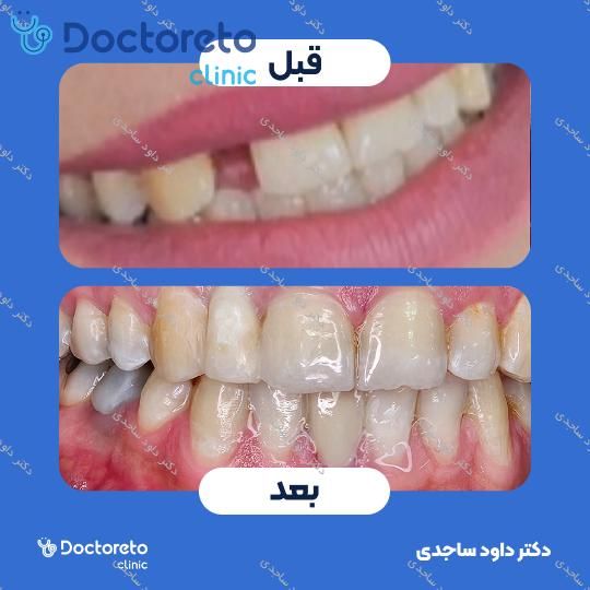 روکش سرامیکی زیرکونیا (هر واحد)