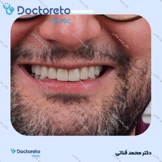 لمینت سرامیکی ایمکس آلمان (هر واحد)