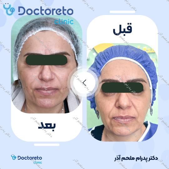بازسازی صورت به روش تزریق چربی در (کل صورت)