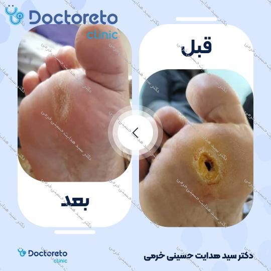 درمان زخم دیابت با روش اوزون تراپی