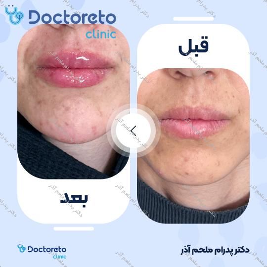 تزریق ژل لب با برند فیورج (1cc)