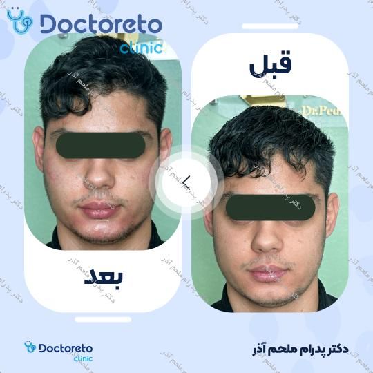 تزریق ژل گونه با برند فیورج (1cc)