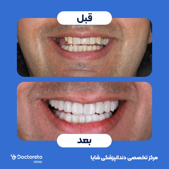 لمینت آی پی اس ایمکس تمام دیجیتال (هر واحد)