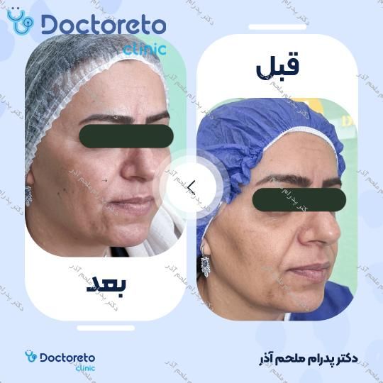 بازسازی صورت به روش تزریق چربی در (کل صورت)