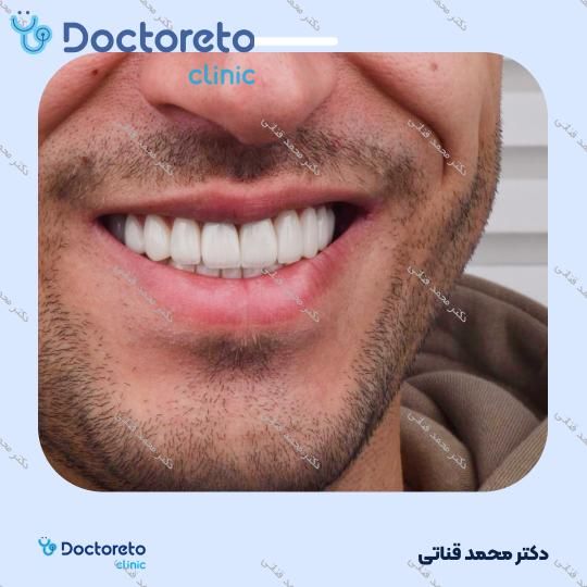 لمینت سرامیکی ایمکس آلمان (هر واحد)