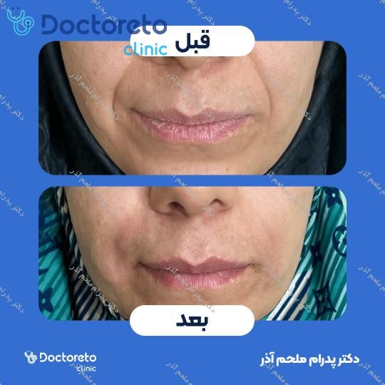 تزریق ژل خط خنده با برند ژوابکس (1cc)