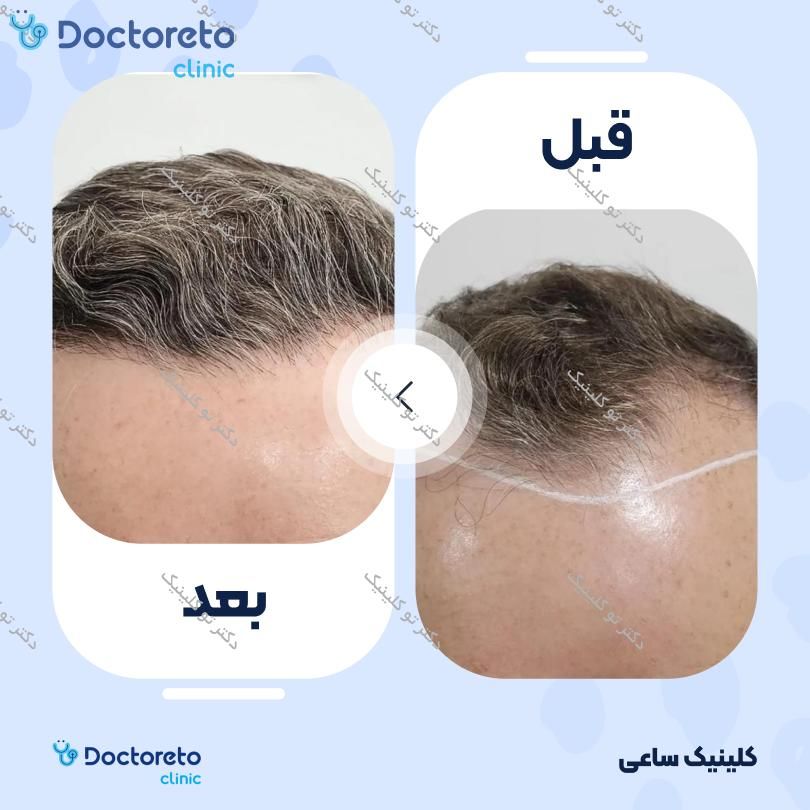نمونه های کاشت مو