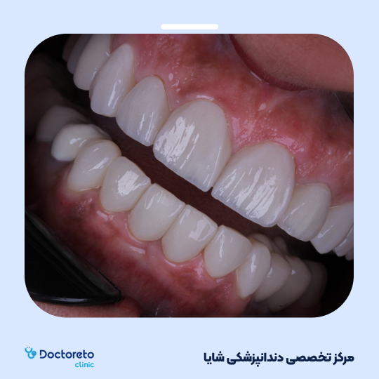 لمینت آی پی اس ایمکس تمام دیجیتال (هر واحد)