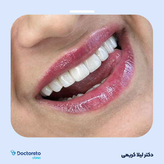 ونیر کامپوزیت توکویاما ژاپنی (هر واحد)