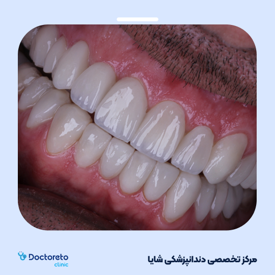 لمینت آی پی اس ایمکس تمام دیجیتال (هر واحد)