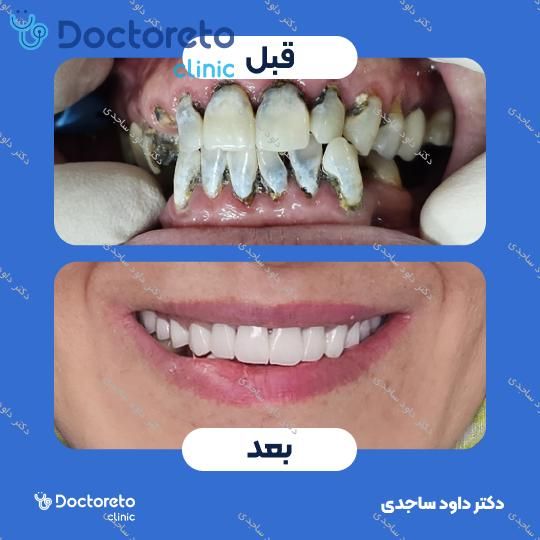 لمینت سرامیکی ایمکس (هر واحد)
