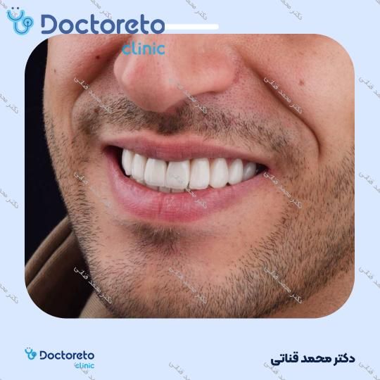 لمینت سرامیکی ایمکس آلمان (هر واحد)