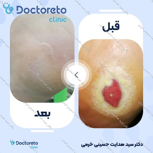 درمان زخم دیابت با روش اوزون تراپی