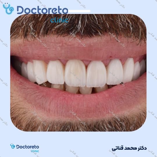 لمینت سرامیکی ایمکس آلمان (هر واحد)