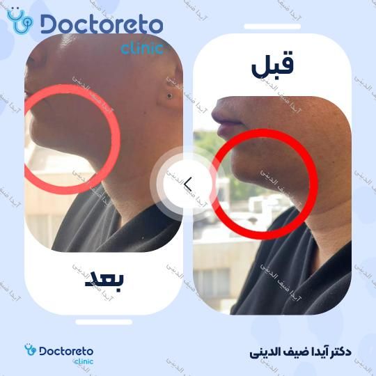 رفع غبغب با دستگاه RF (بانوان) (هر جلسه)