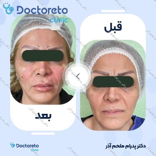 بازسازی صورت به روش تزریق چربی در (کل صورت)