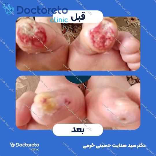 درمان زخم دیابت با روش اوزون تراپی
