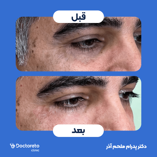تزریق ژل زیرچشم با برند اینووسنس (1cc)