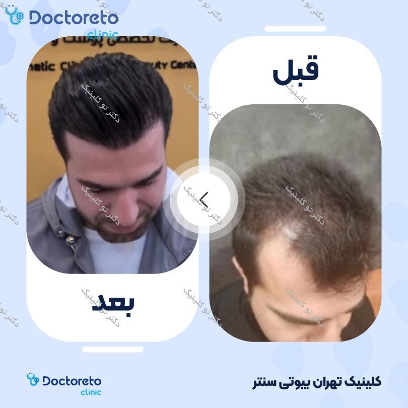 نمونه های کاشت مو