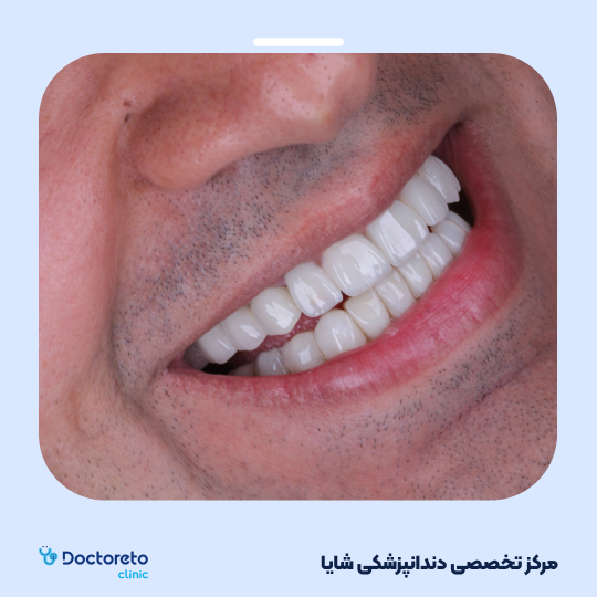 لمینت آی پی اس ایمکس تمام دیجیتال (هر واحد)