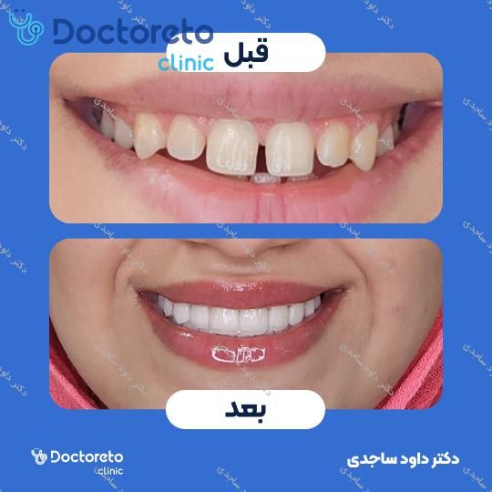 لمینت سرامیکی ایمکس (هر واحد)