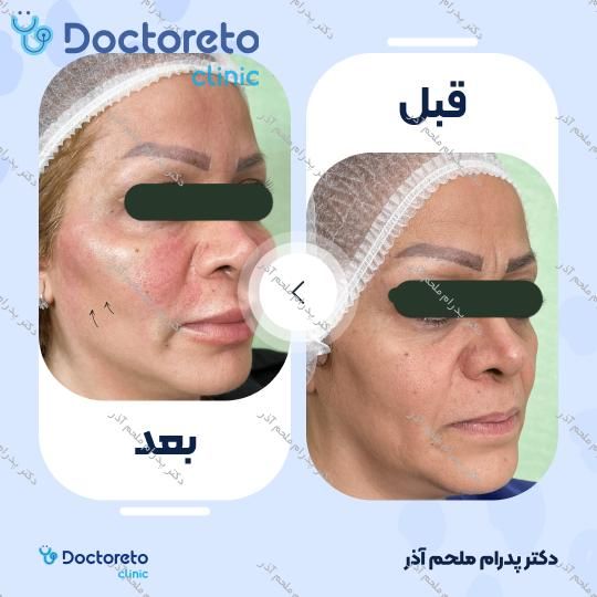 بازسازی صورت به روش تزریق چربی در (کل صورت)