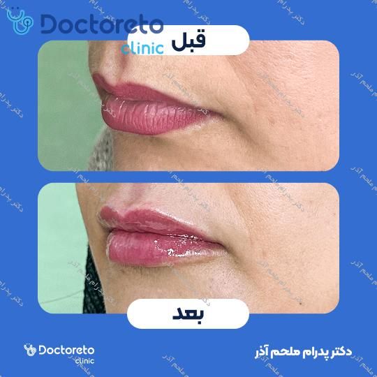تزریق ژل لب با برند فیورج (1cc)