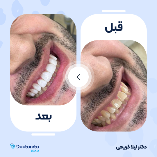 ونیر کامپوزیت توکویاما ژاپنی (هر واحد)