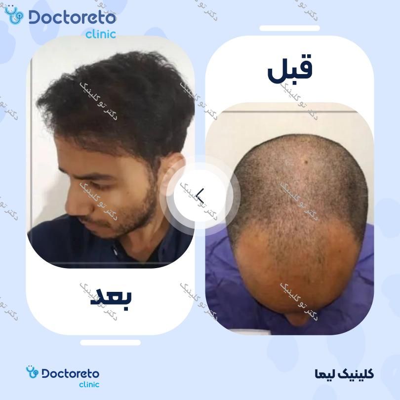 نمونه های کاشت مو