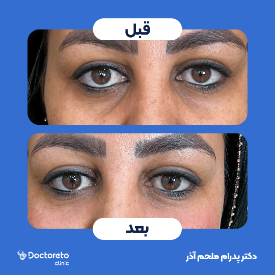 تزریق ژل زیرچشم با برند اینووسنس (1cc)
