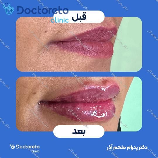 تزریق ژل لب با برند فیورج (1cc)