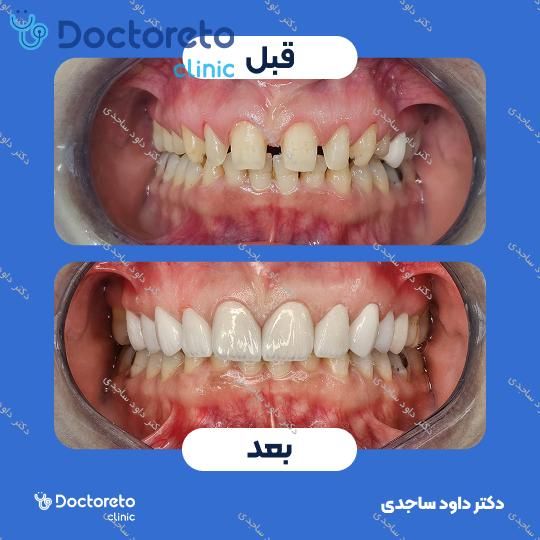 روکش سرامیکی زیرکونیا (هر واحد)