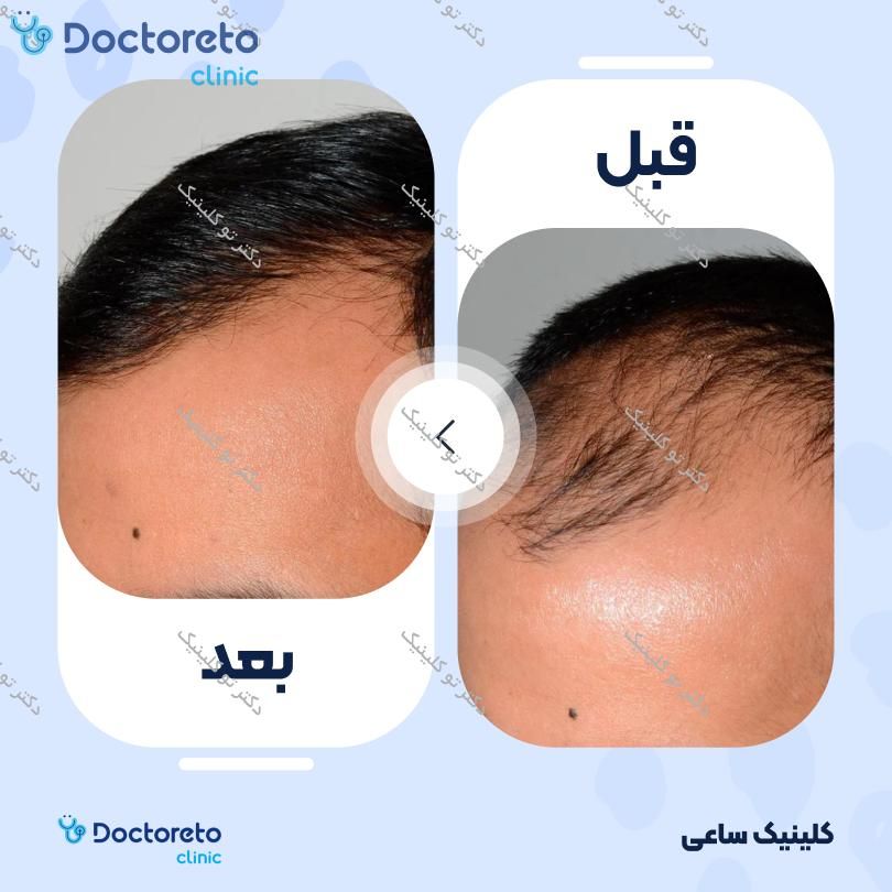 نمونه های کاشت مو