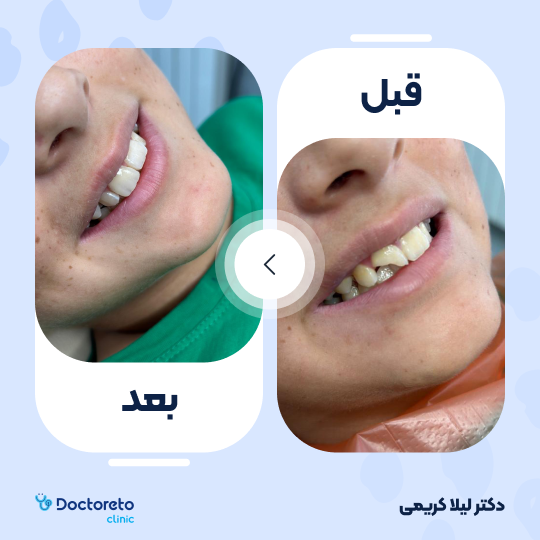 ونیر کامپوزیت توکویاما ژاپنی (هر واحد)