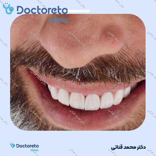 لمینت سرامیکی ایمکس آلمان (هر واحد)