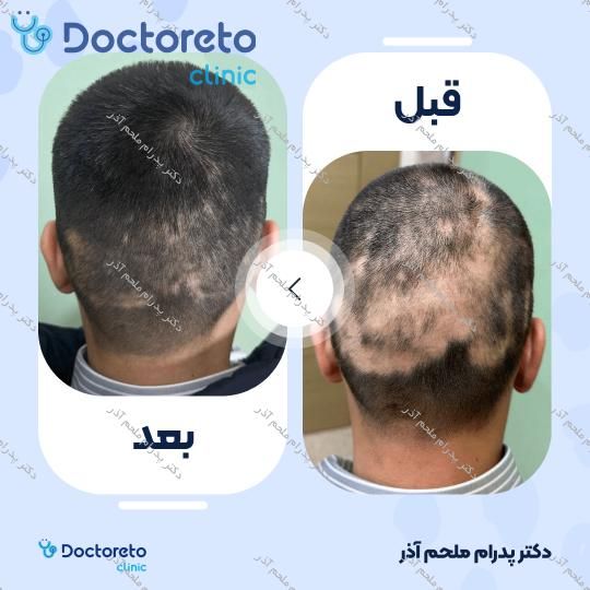 مزوتراپی برای درمان ریزش مو با برند mccn (هر جلسه)