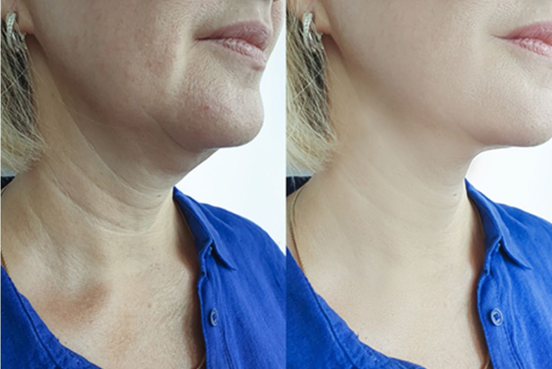 جوانسازی گردن و دکلته با تزریق مزوژل برند رمدیوم آکوا ( هرجلسه )