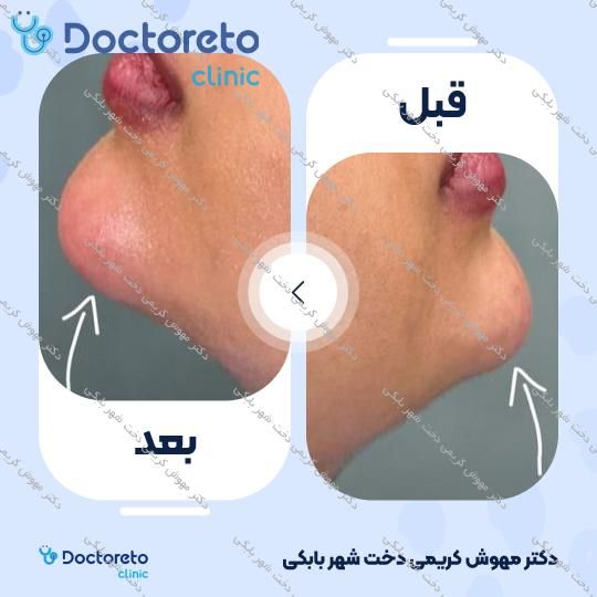 تزریق ژل چانه با برند EPTQ (هر سی سی)