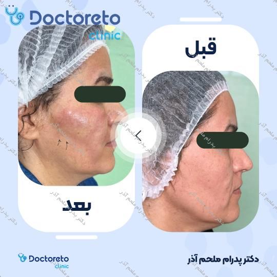 بازسازی صورت به روش تزریق چربی در (کل صورت)