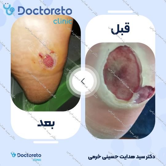 درمان زخم دیابت با روش اوزون تراپی
