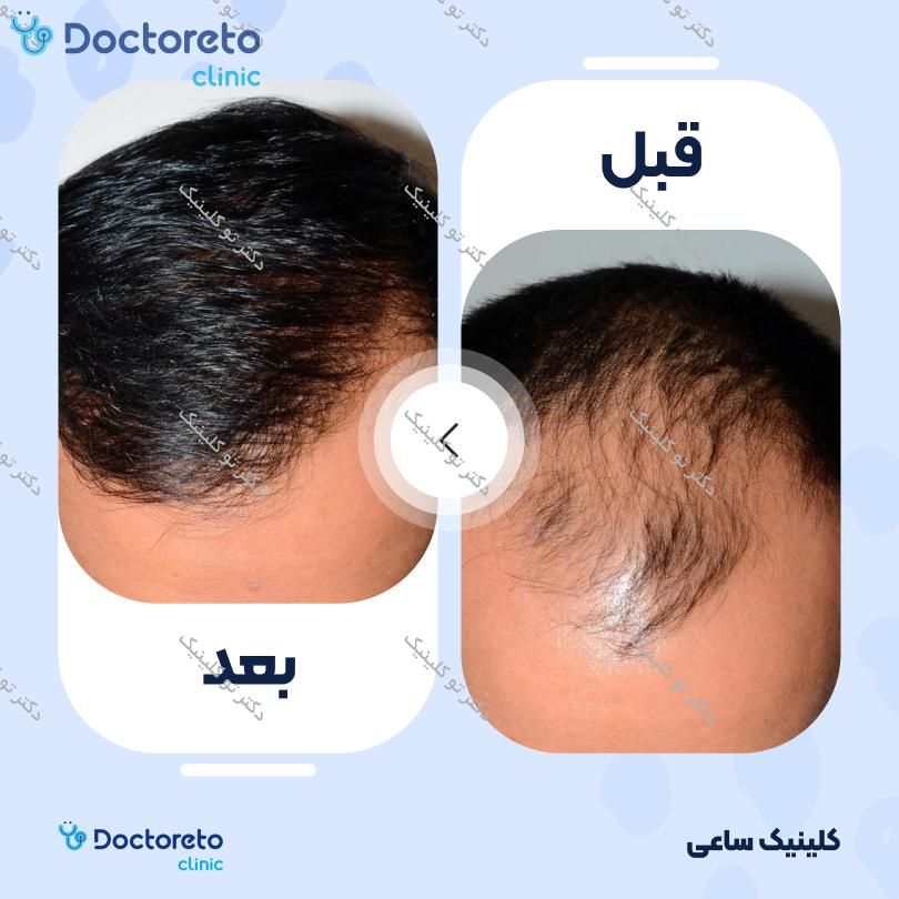 نمونه های کاشت مو