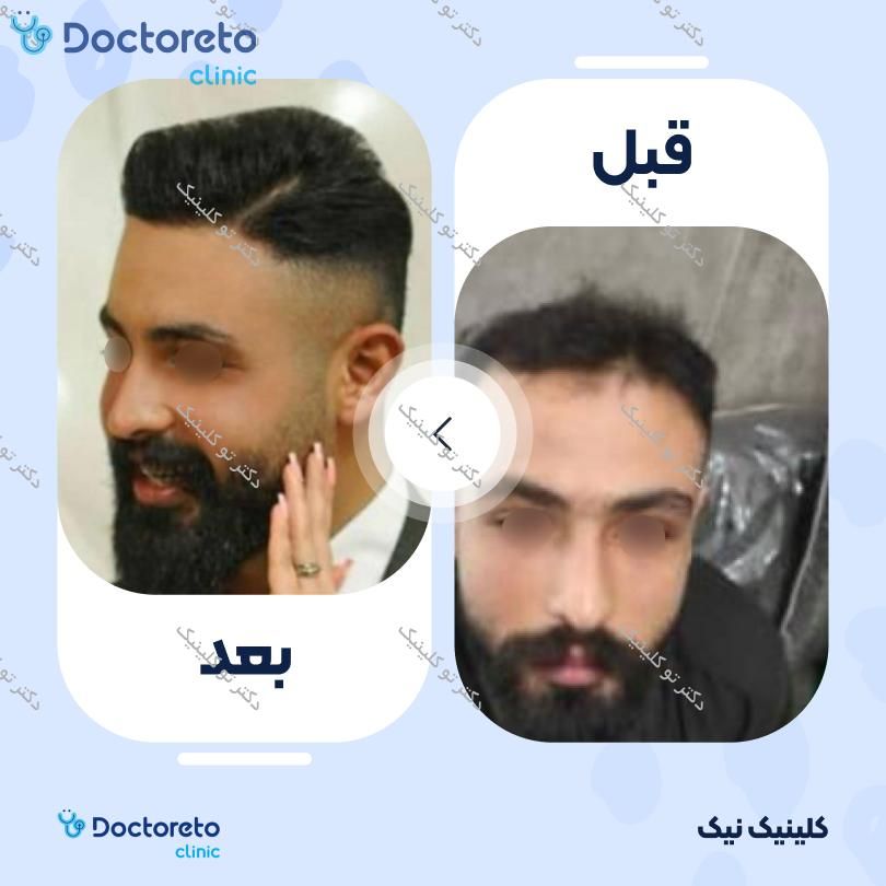 نمونه های کاشت مو