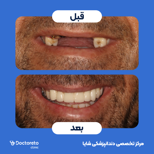 لمینت آی پی اس ایمکس تمام دیجیتال (هر واحد)