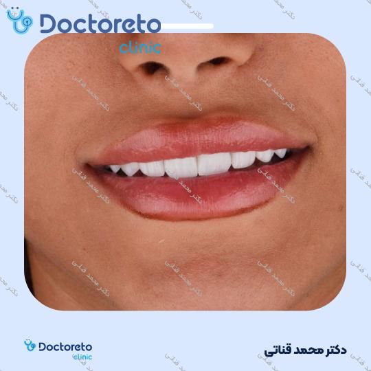 لمینت سرامیکی ایمکس آلمان (هر واحد)