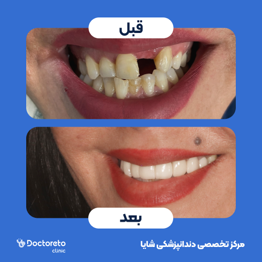 لمینت آی پی اس ایمکس تمام دیجیتال (هر واحد)