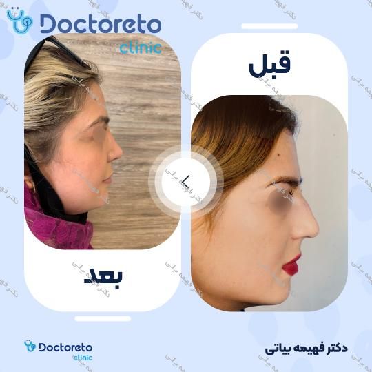 عمل زیبایی بینی (رینوپلاستی)