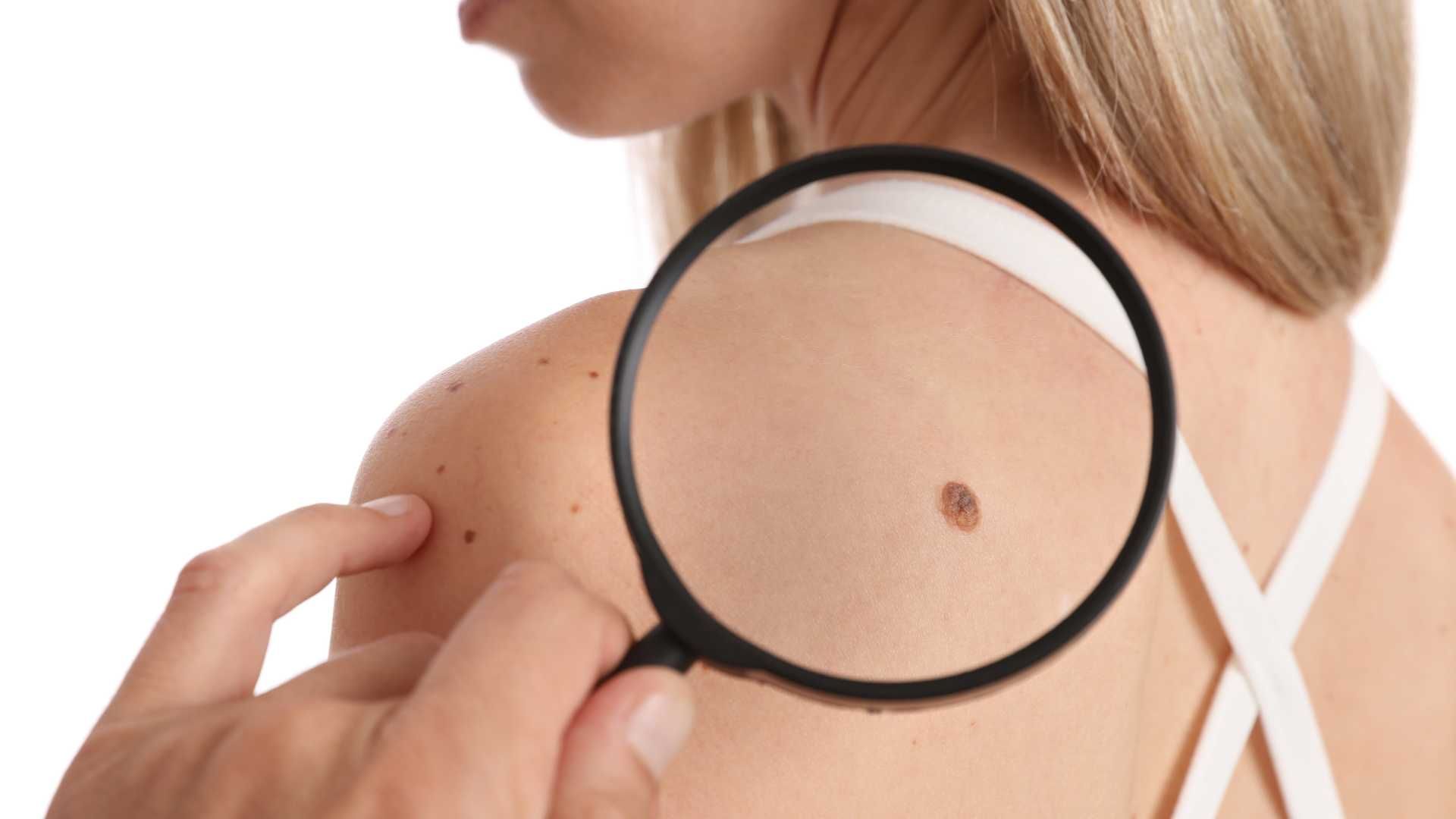 برداشت خال با دستگاه الکتروکوتر (هر جلسه)